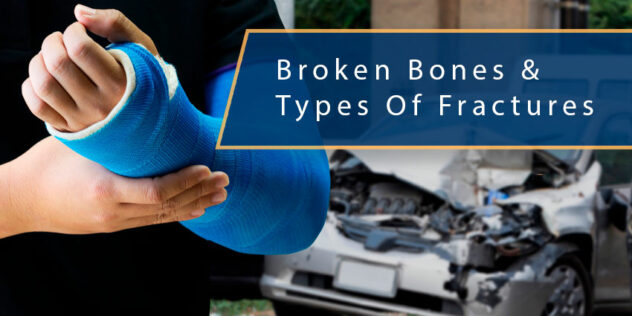 Broken Bones & Types of Fractures From Motor Vehicle Collisions